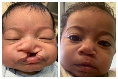 Facial, Lip & Palate Clefts